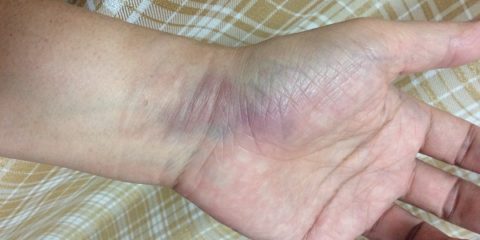 実際の画像:ファウルボール直撃、左腕手首の衝撃と打撲